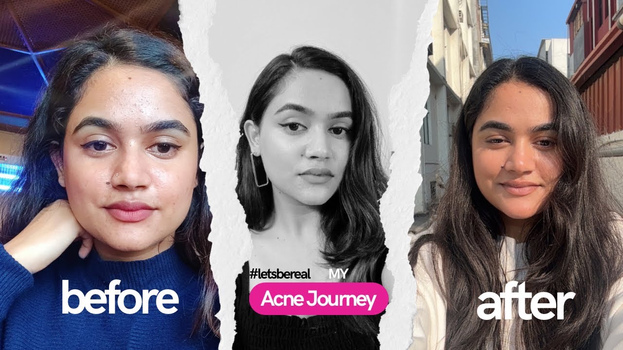 If You Have Acne, Combination & Sensitive Skin - You’re Not Alone | My Journey