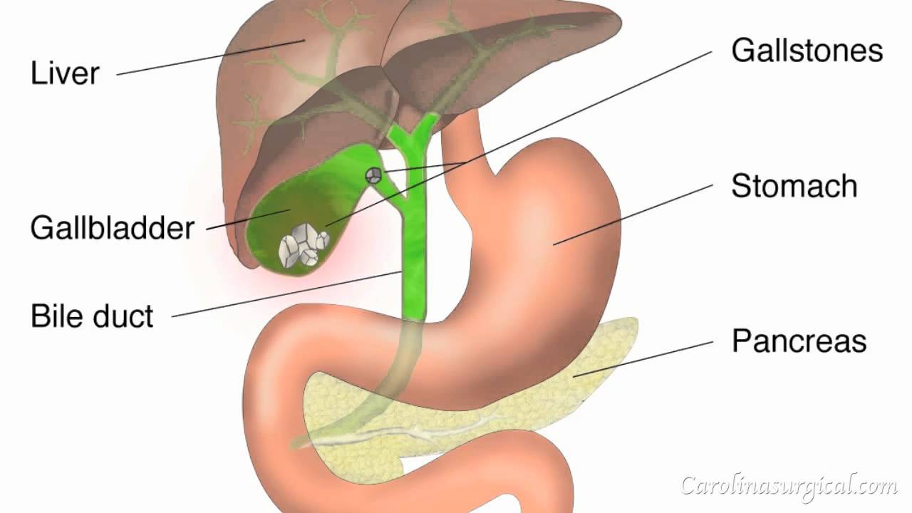 Gallbladder Removal Surgery Animation