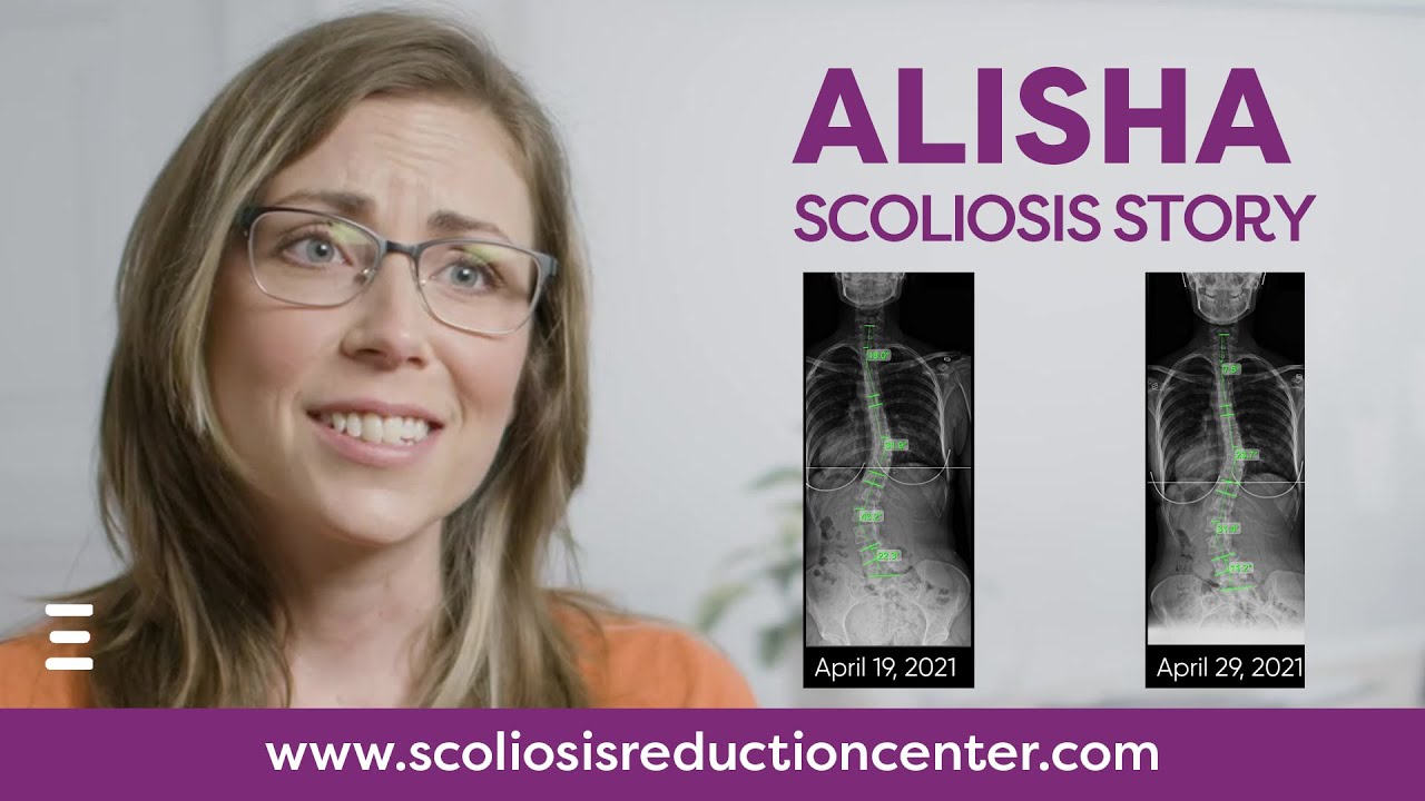 Adult Scoliosis Alternative Treatment Without Surgery, Alisha's Story