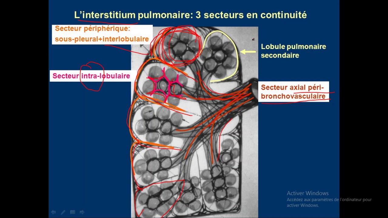 syndrome interstitiel en détails 01