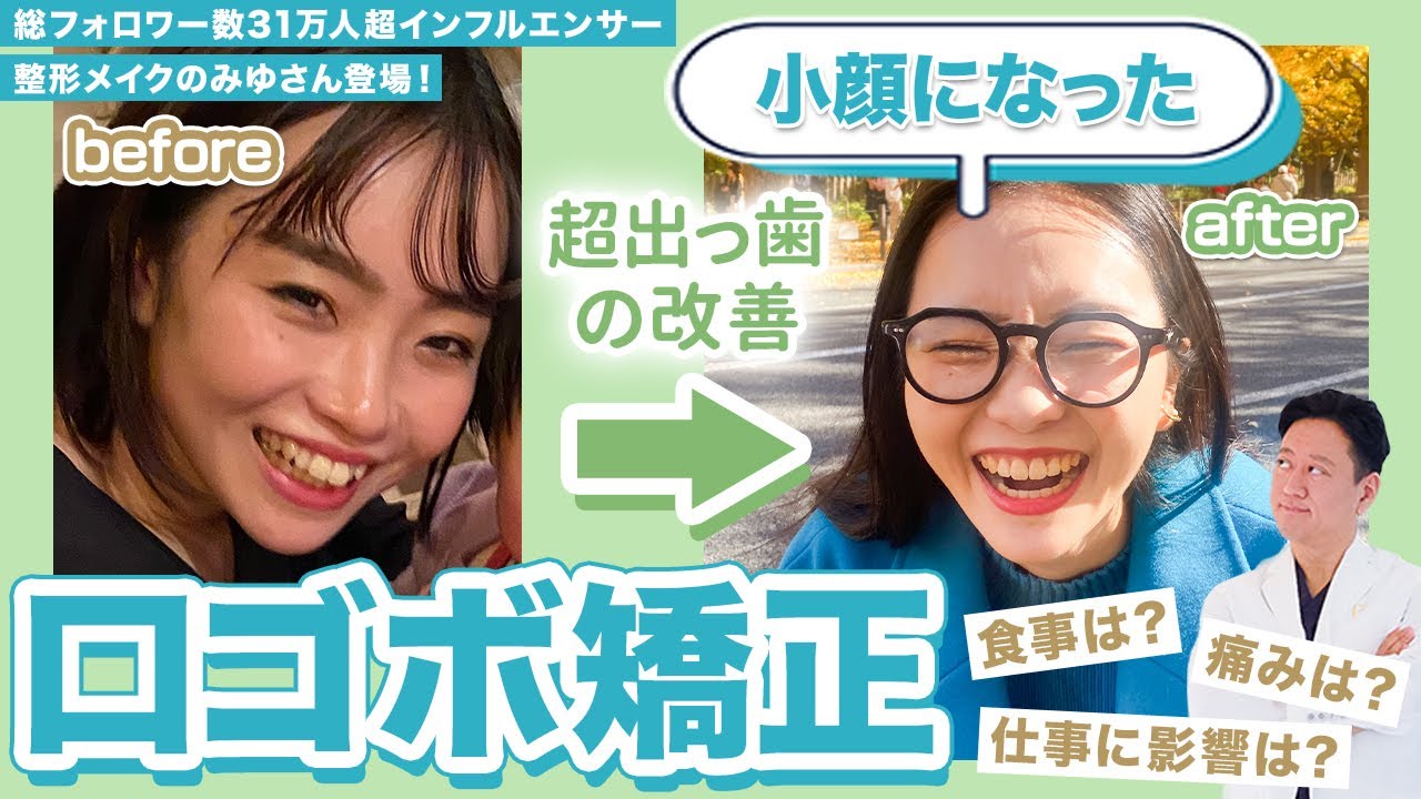 出っ歯の改善で小顔に？整形メイクのみゆさんが矯正時の痛みや装置がなん度も外れた話をしてくださいました【審美歯科 歯列矯正 歯並び】