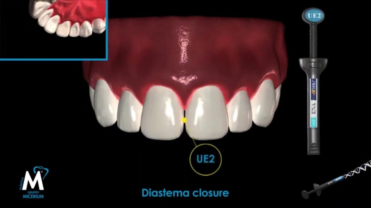 SISTEMA DE RESINAS MICERIUM ENA HRI Técnica de Estratificación