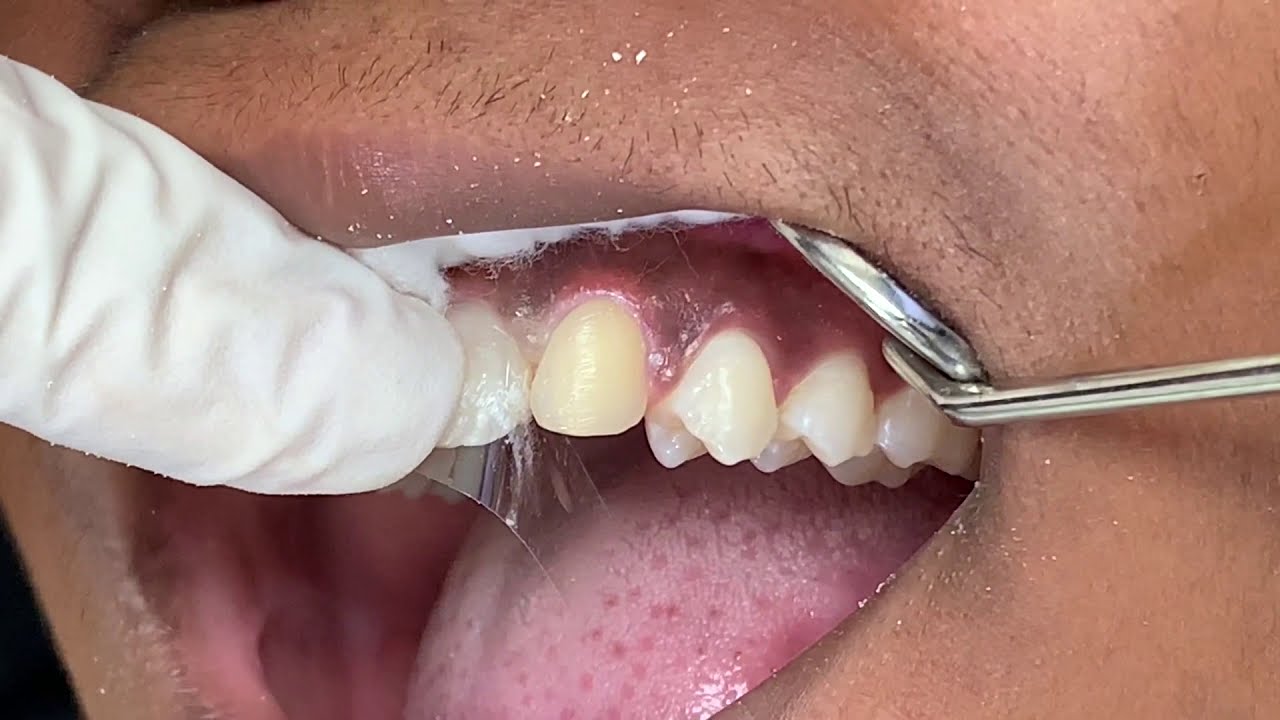 Houston Cosmetic Dentist...Amazing affordable Cosmetic bonding technique to look like veneers!