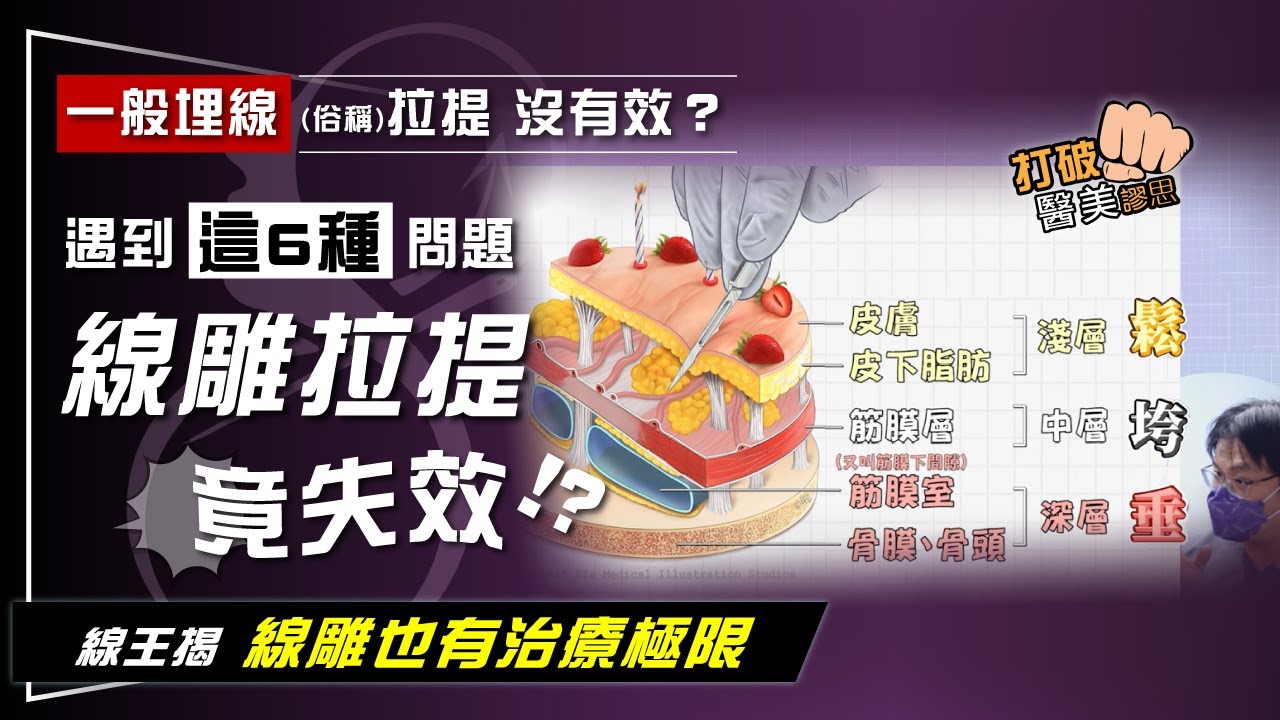 為何一般埋線(俗稱)拉提沒有效？  線王點出6原因！　有「這些問題」不適合線雕拉提 打破醫美謬思312-20240416