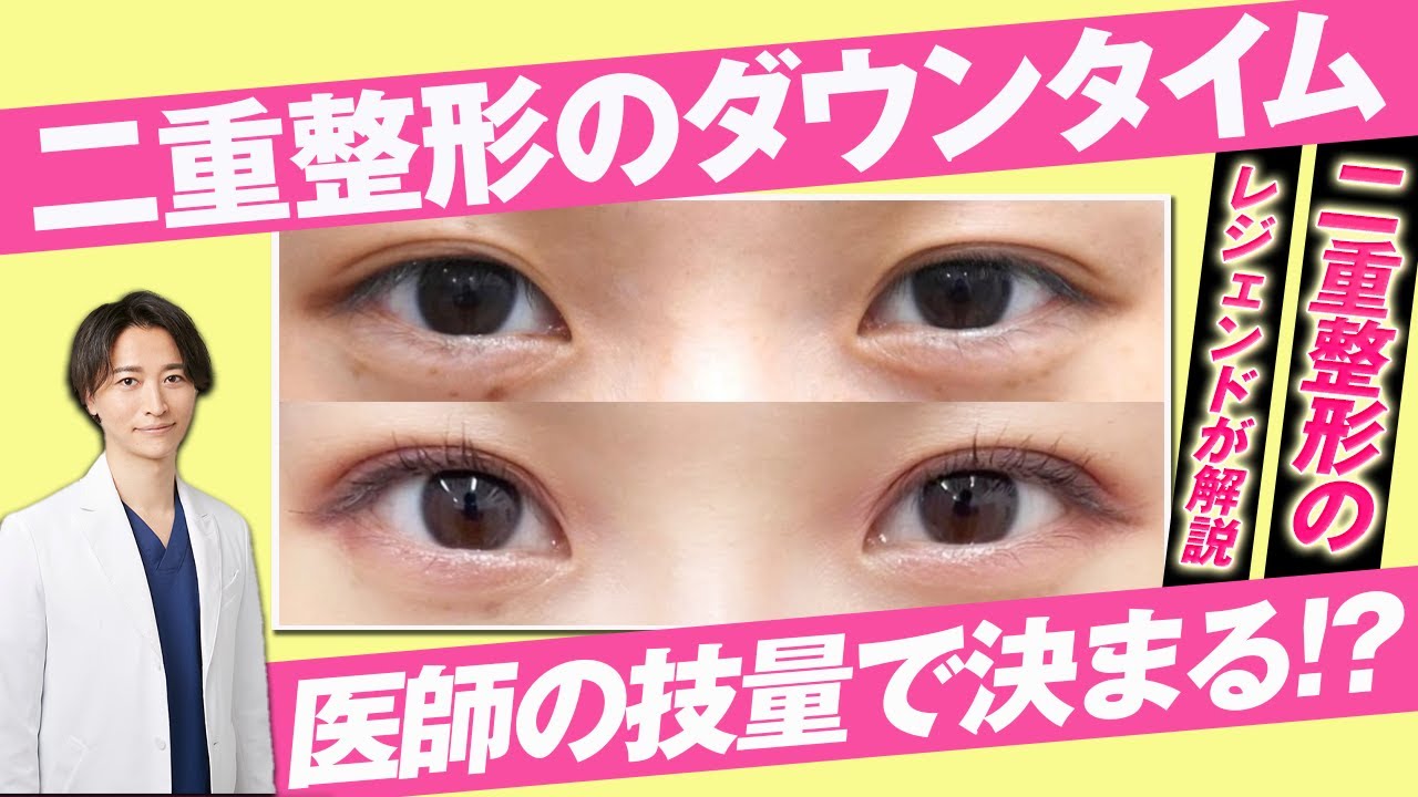 【ダウンタイム】二重整形後の腫れは医師の技量で決まる？二重整形のレジェンドが解説！【二重埋没】