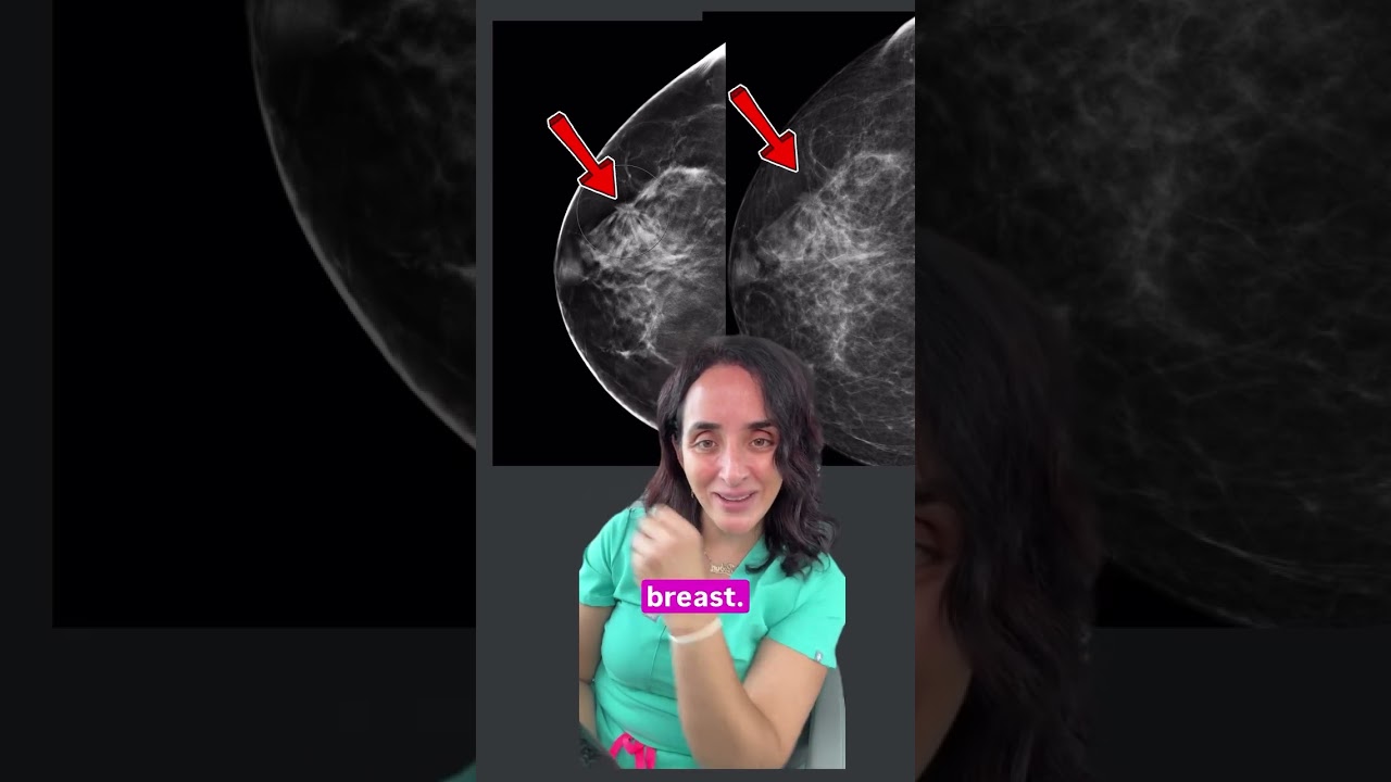 yes! mammograms do work in dense breast tissue (just find yourself a great breast radiologist)