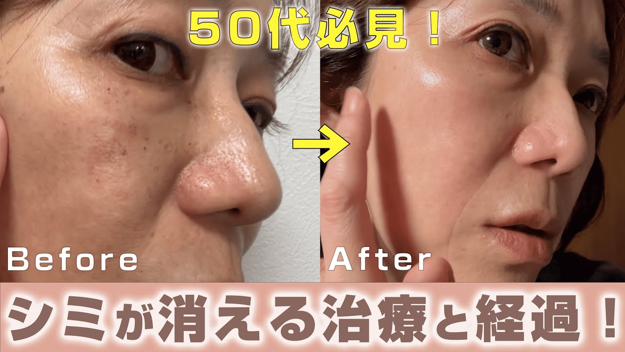 本当にシミが消えた！IPL光治療とピーリング
