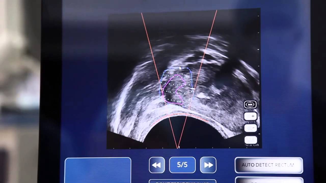 Focal One - Robot-Assisted Prostate Tumorectomy.