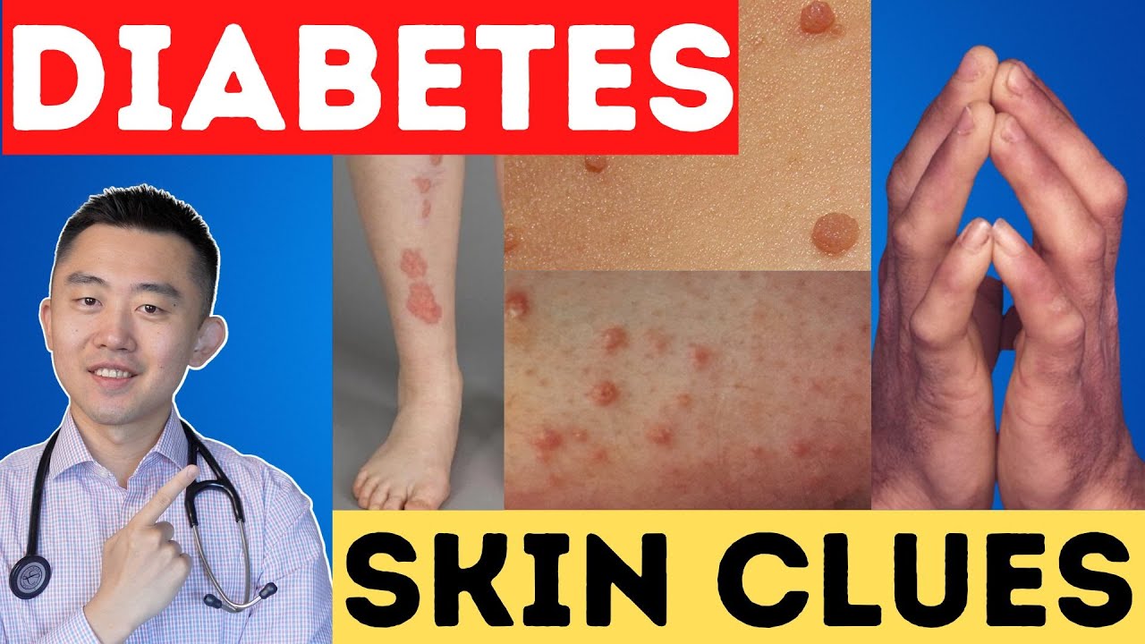 Top 8 Skin Warning Signs of Diabetes and Insulin Resistance