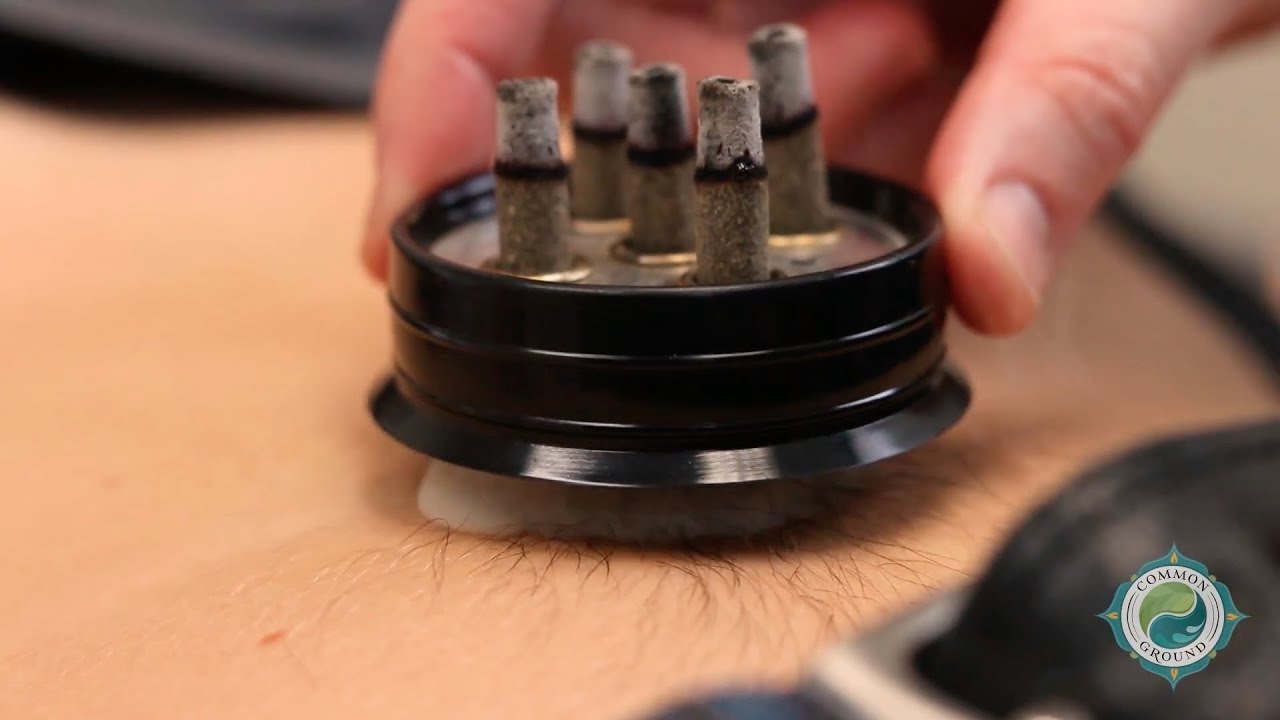 What is Moxibustion?