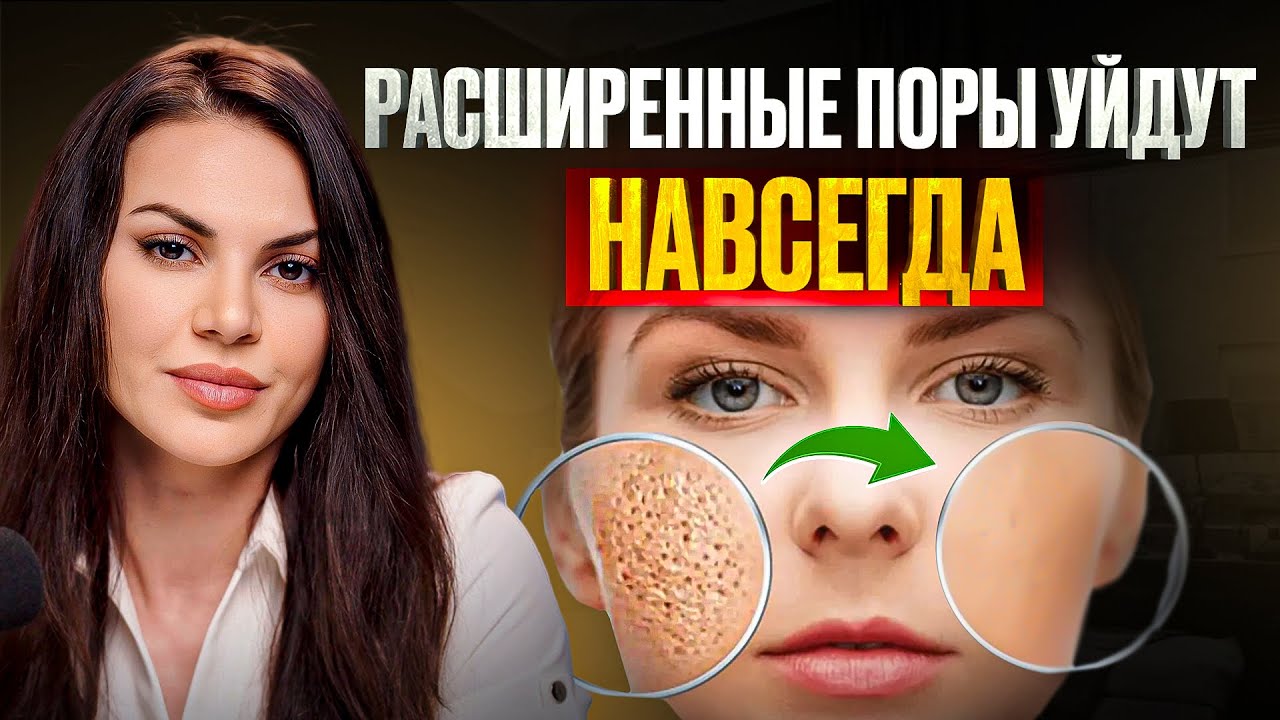 КАК ИЗБАВИТЬСЯ ОТ РАСШИРЕННЫХ ПОР НАВСЕГДА? Все способы!