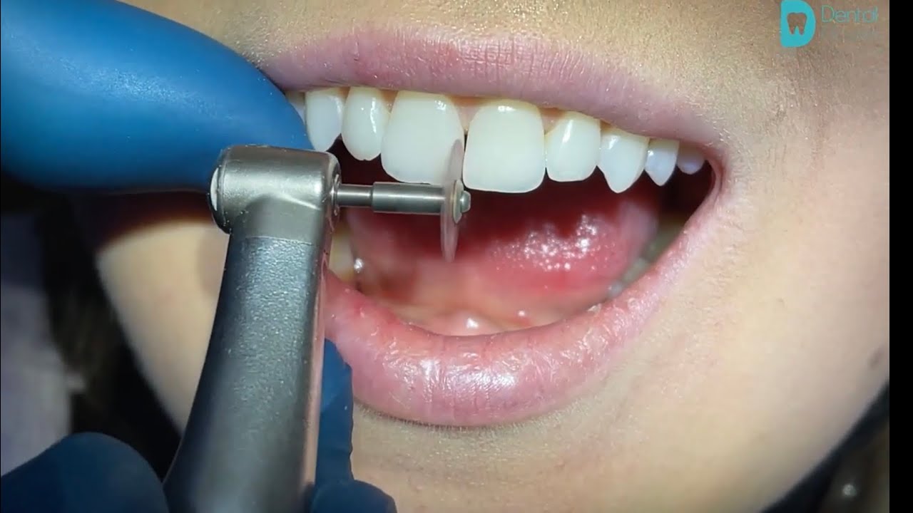 Inter proximal reduction for aligners in malayalam