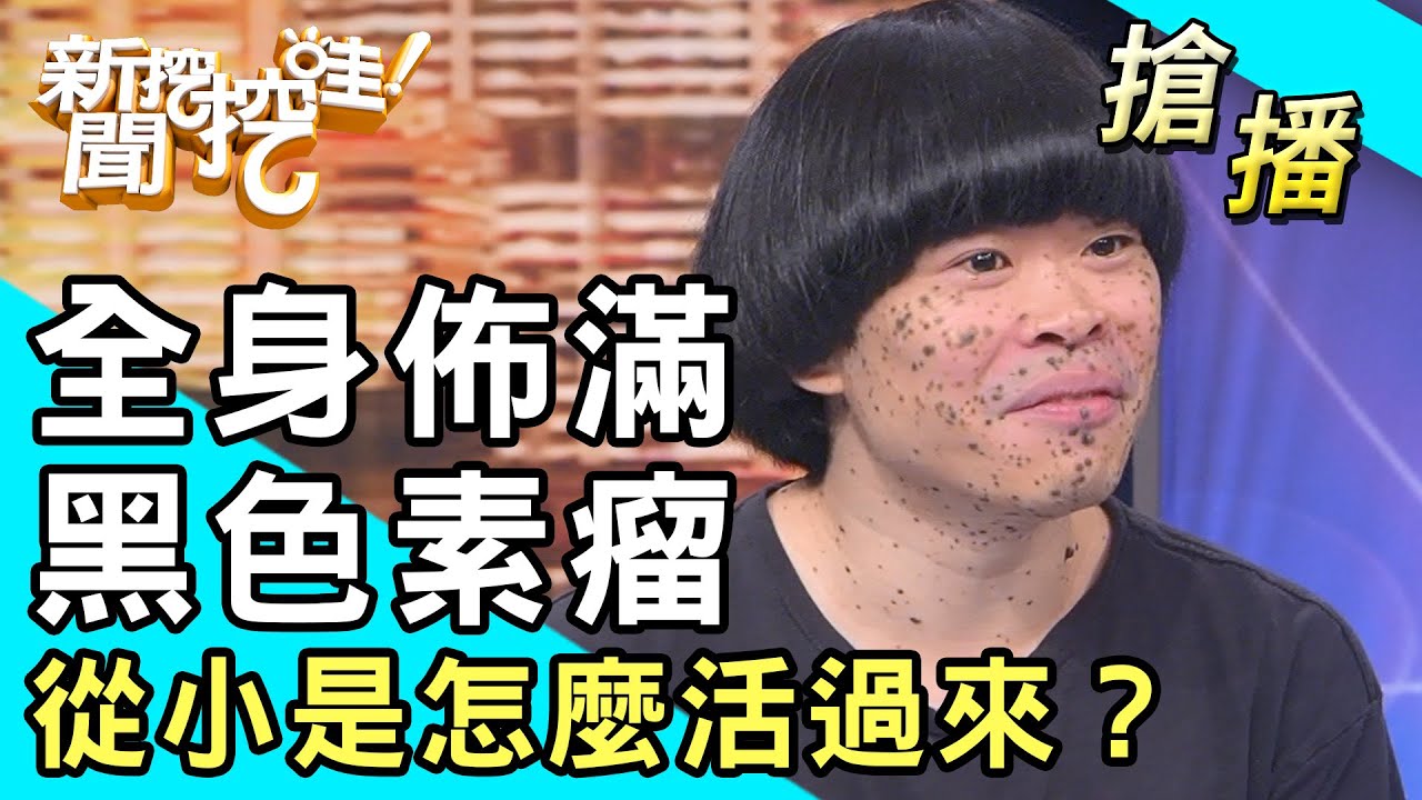 【搶播】全身佈滿黑色素瘤！從小是怎麼活過來？