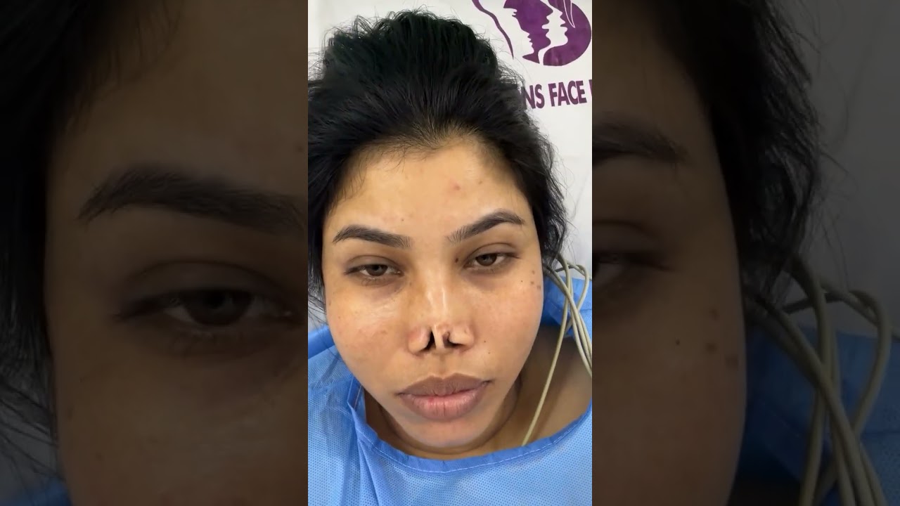 Nasal reconstruction planned with the Indian Flap!!