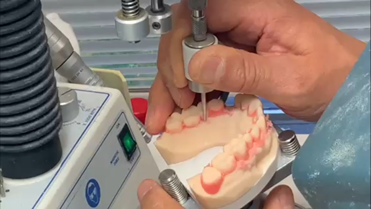 How to Prevent Metal Partial Framework from Loosening