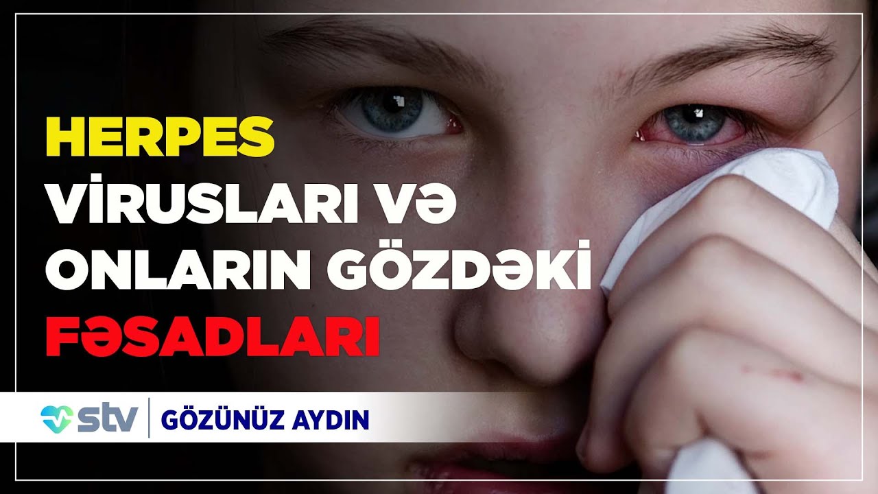 Dodaqda təkrarlanan uçuqlar - HERPES virusları və onların gözdəki fəsadları  (02.09.2020)