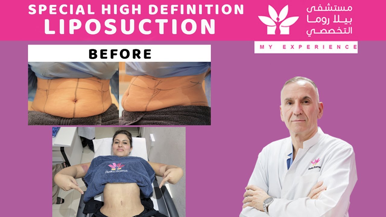 High Definition Liposuction in Bellaroma Hospital | by Doctor Zoran Lekic