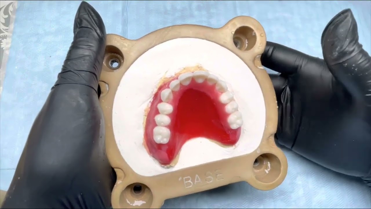 Inclusão de Prótese Total com muralha de silicone