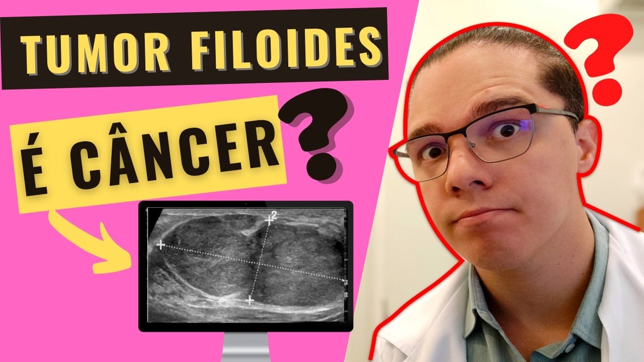 TUMOR FILOIDES É CÂNCER? Entenda como é feito o diagnóstico (benigno x maligno) e o tratamento!
