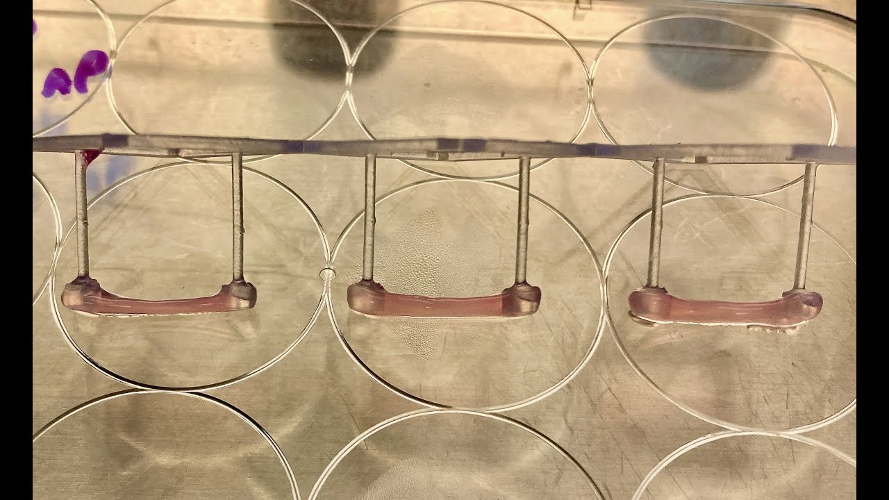 Bone in dish - Paget's disease