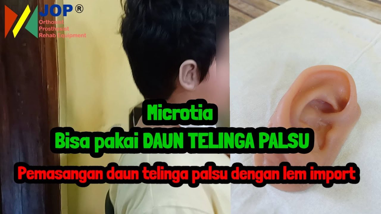 Microtia bisa pakai DAUN TELINGA PALSU | JOP Official