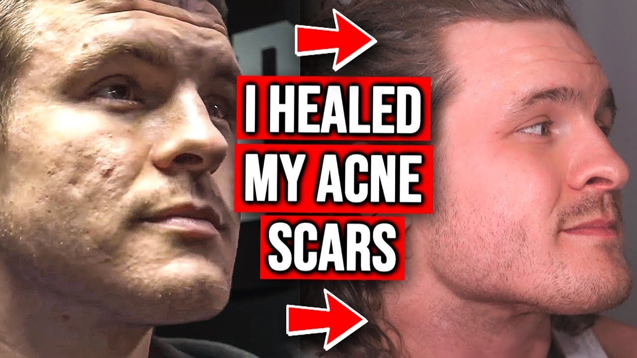 How I FINALLY Got Rid of My Acne Scars!