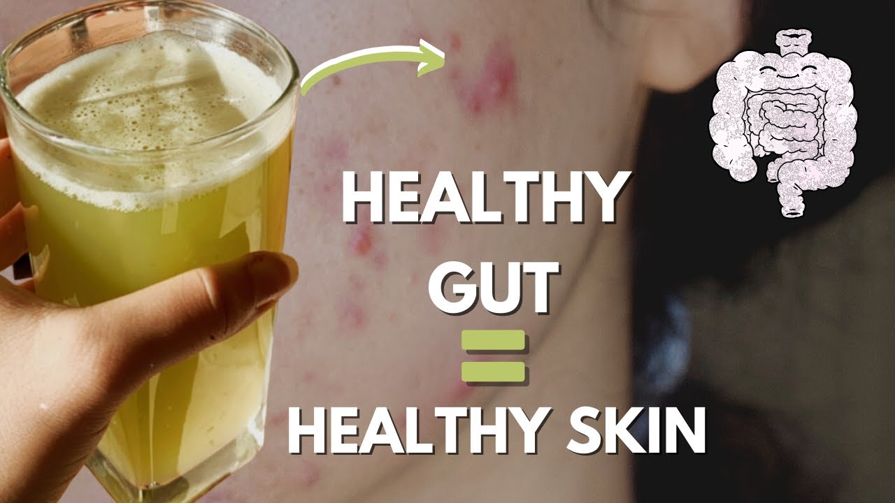 Gut Healthy Foods You Need in Your Acne Healing Journey