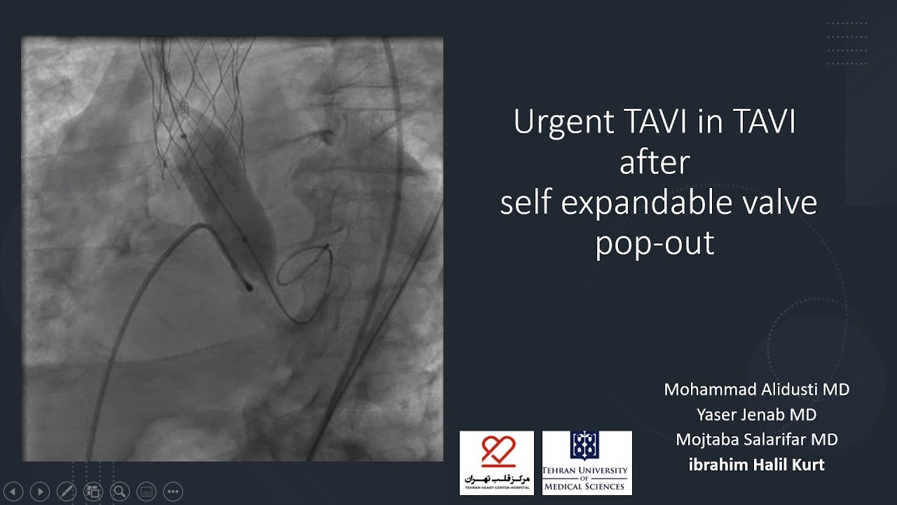 Urgent TAVI in TAVI after self expandable valve  pop out