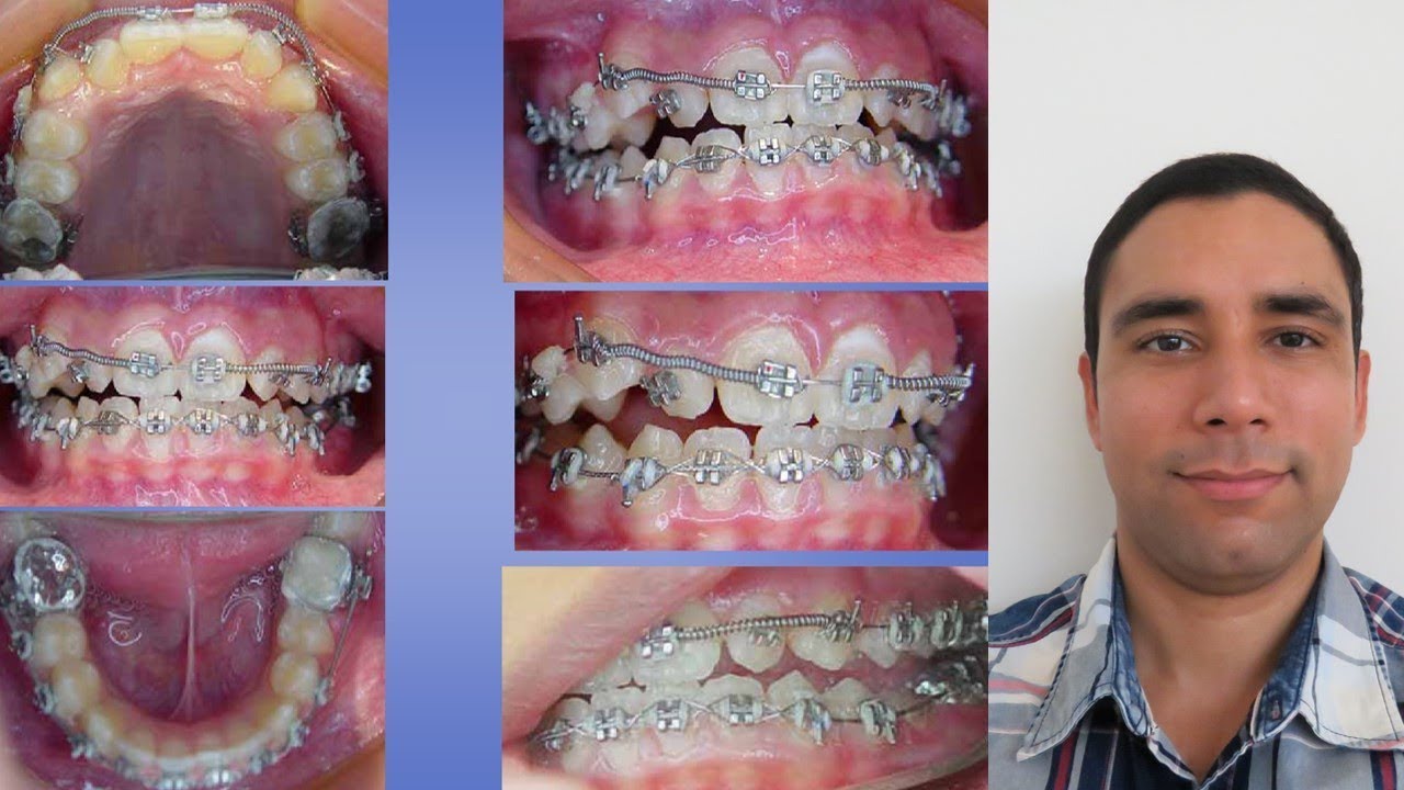 Sabes como se abren espacios con resorte de Niti para ubicar los dientes?? Te explico!