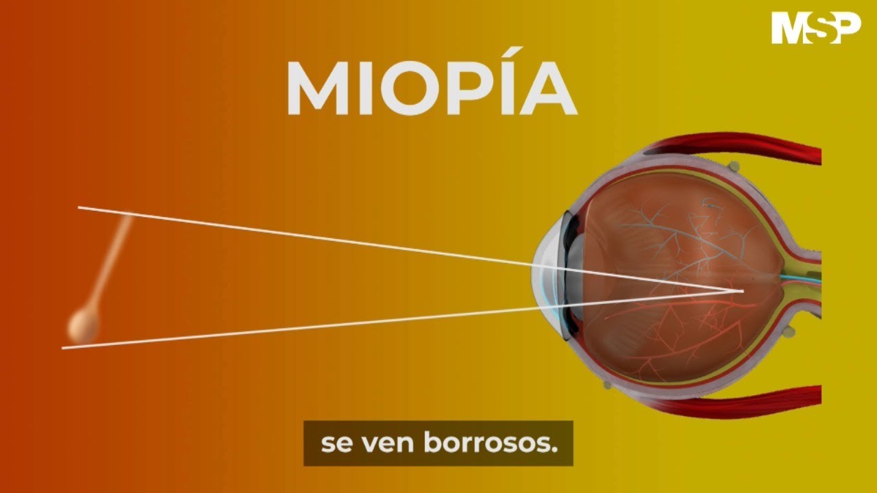 Miop&iacute;a