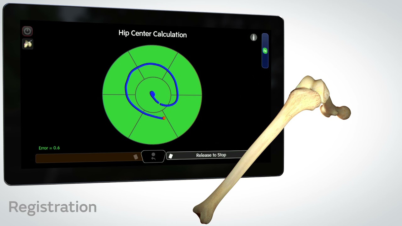 Cori Robotic im OP – Chirurgische Anwendung in der Knieendoprothetik (UKA Animation 22797)