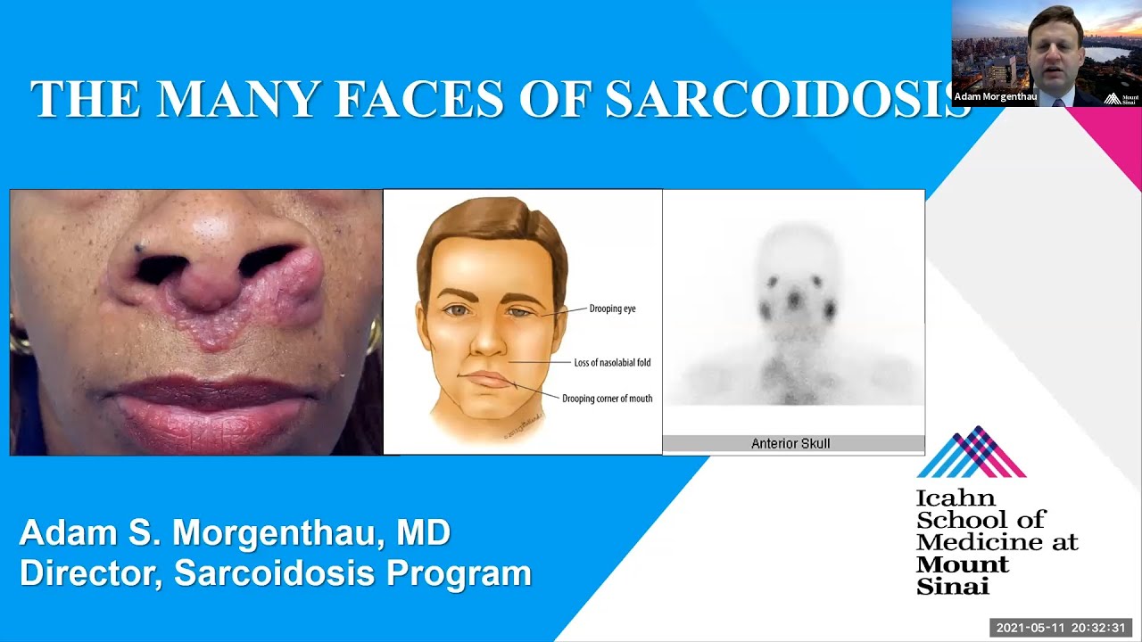 The Many Faces of Sarcoidosis