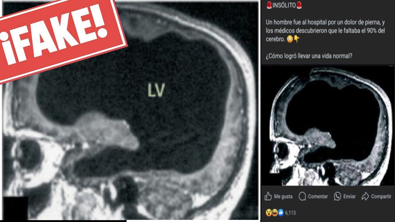 El Hombre Que Vivió Sin El 90% De Su Cerebro | Desmintiendo Imágenes Con Historias De Terror #29