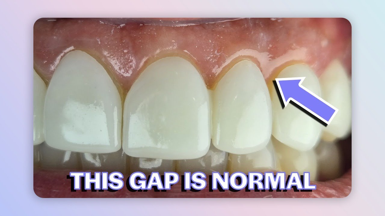 No-Prep Veneers: Try-in Fit vs Bonded Fit  - Dr Joyce Kahng