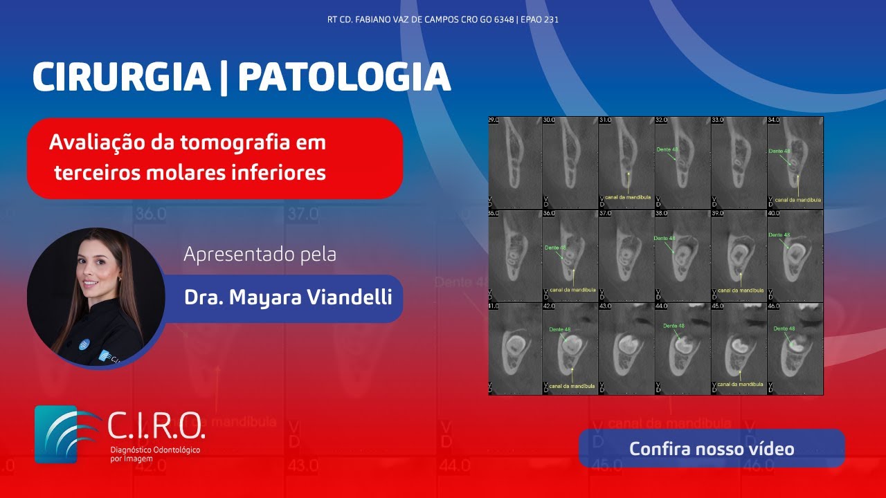 Avaliação de tomografia de terceiros molares