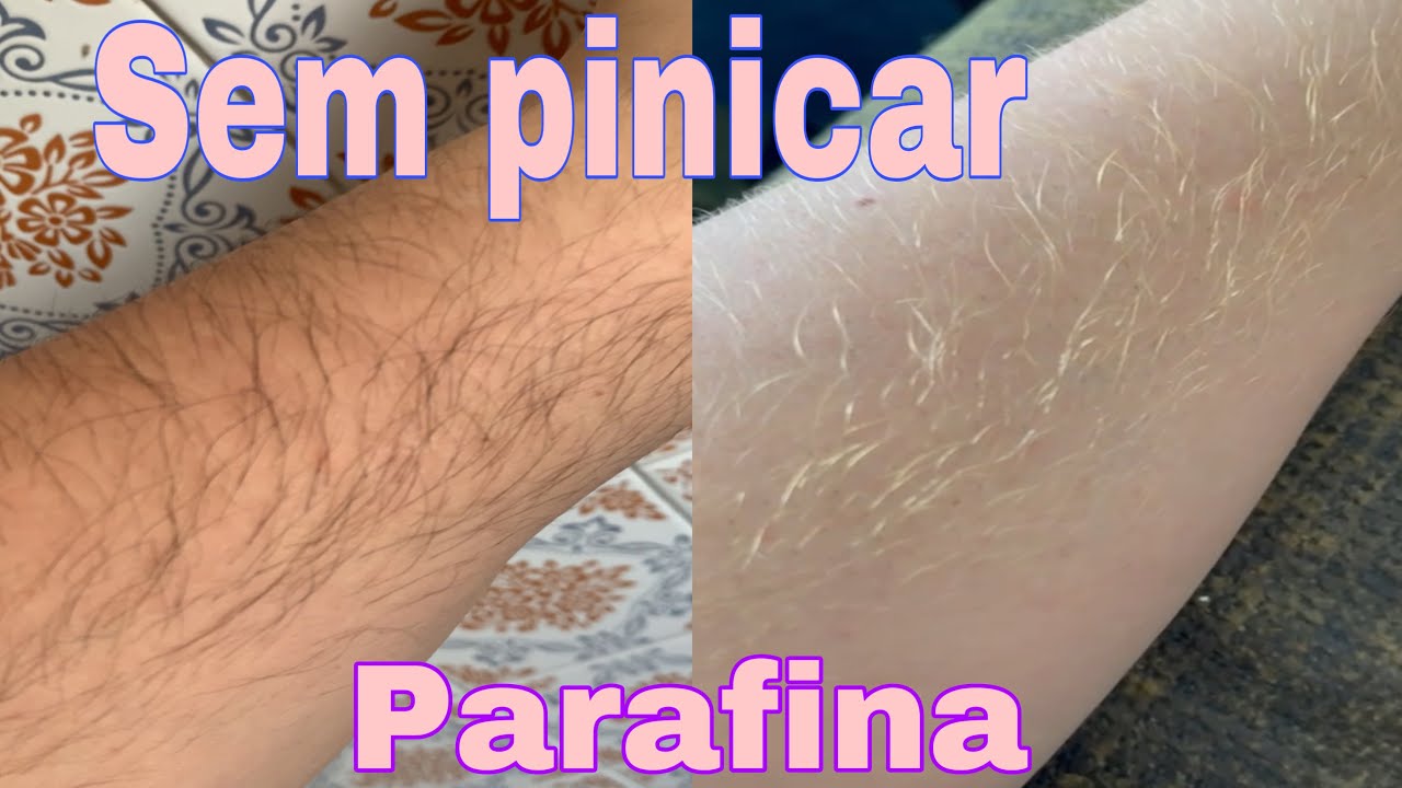 Como descolorir pelos sem pinicar (arder)