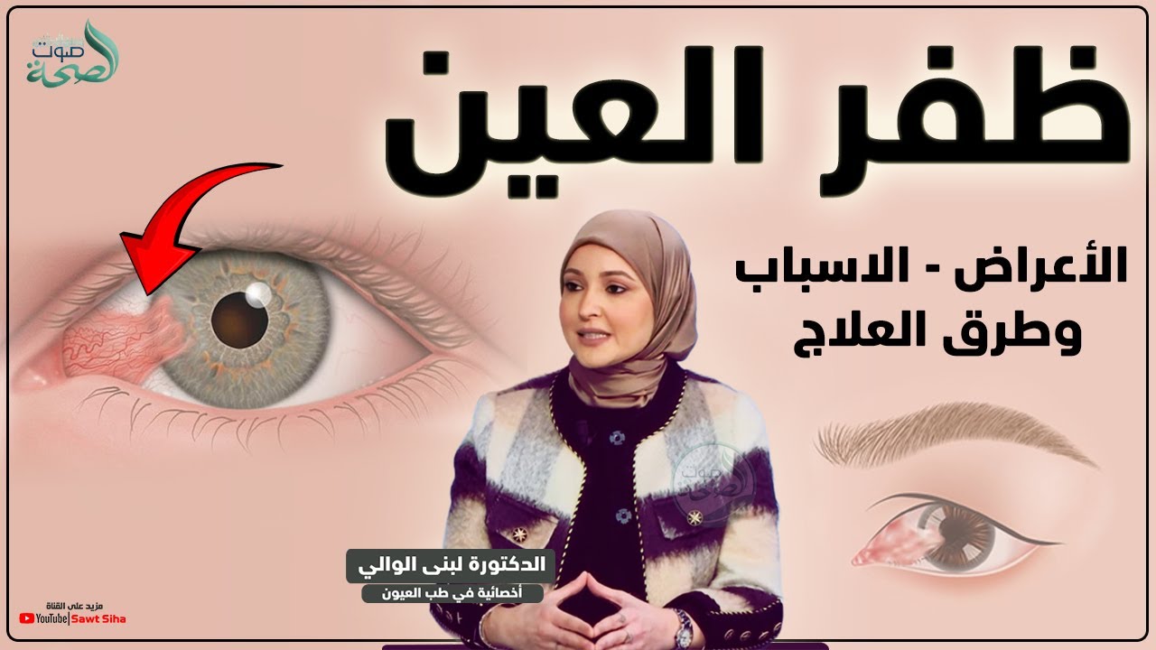 ظفر العين : الاسباب، الاعراض، وطرق العلاج مع أخصائي في طب العيون لبنى الوالي
