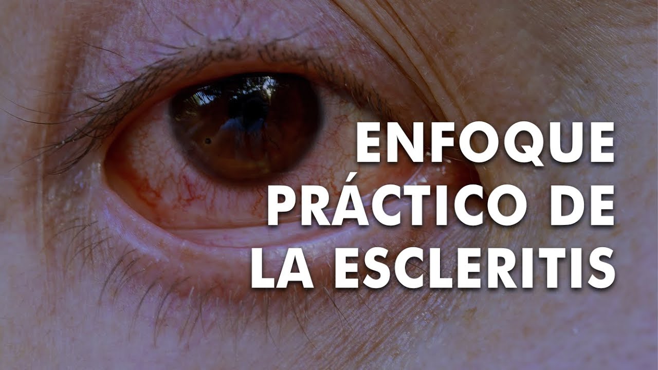 Enfoque pr&aacute;ctico de la escleritis Dra. Natalia Suarez 22 Septiembre 2023