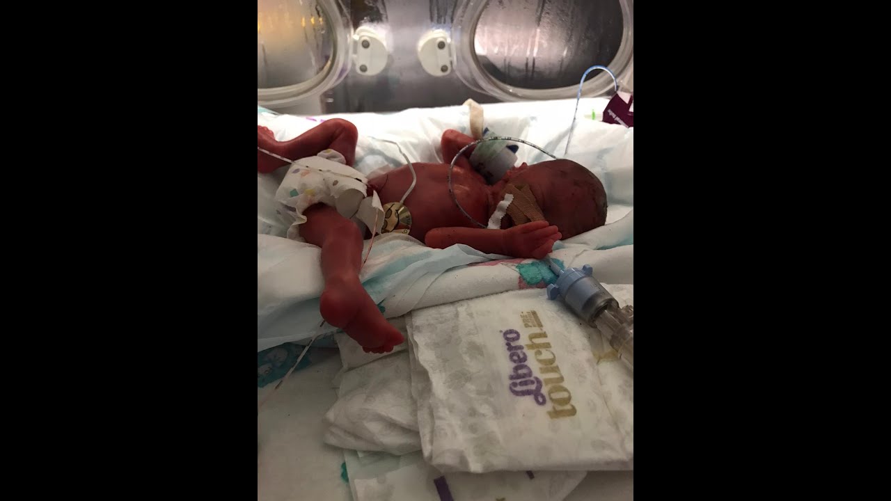Laura's story of PPROM at 18 weeks and 1 day 141