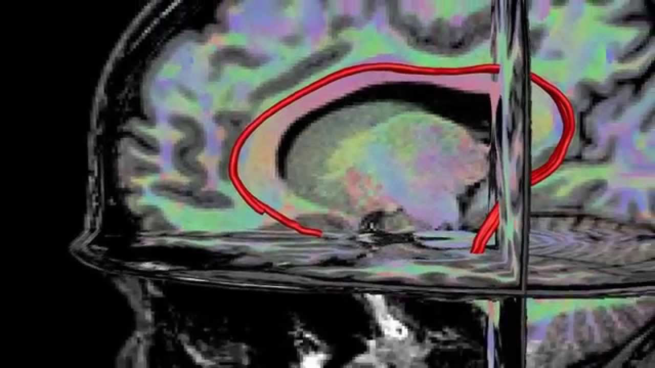 Diffusion MRI combined with T1 weighted MRI