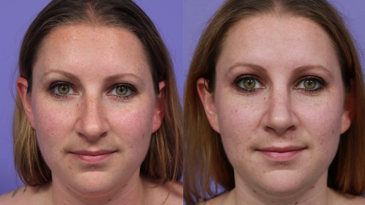 Rhinoplasty at Stoker Plastic Surgery | Los Angeles