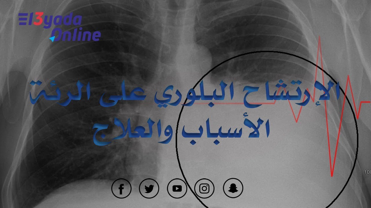 العيادة أونلاين - ما هو الارتشاح البلوري للدكتور  احمد مصطفى