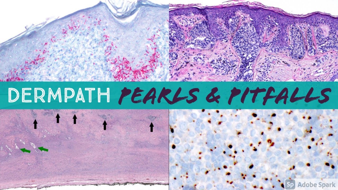 Dermpath Pearls & Pitfalls for General Surgical Pathologists