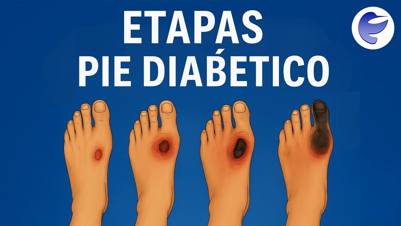 Conoce las etapas del Pie Diabético