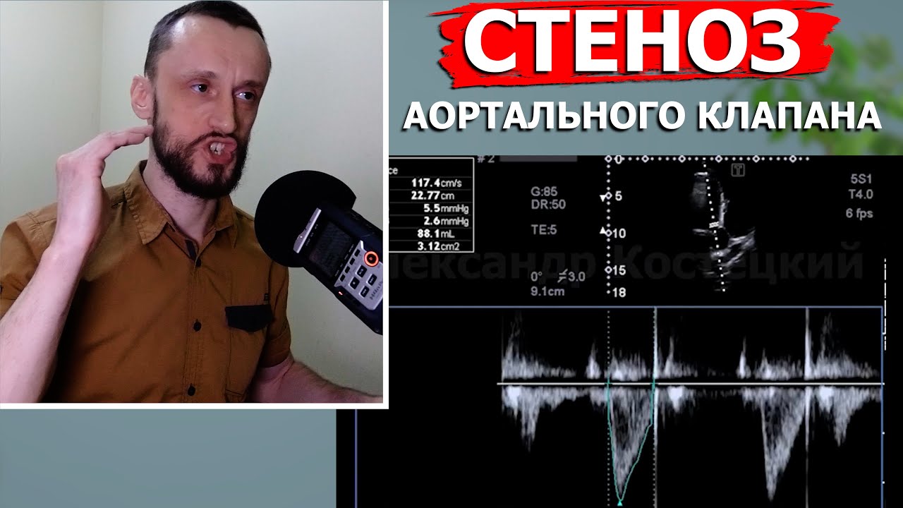 Определение степени стеноза аортального клапана | Расчет площади