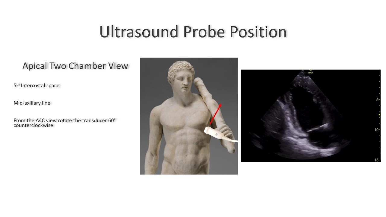 Apical Two Chamber (A2C) View. Perioperative & Critical Care ECHO/ POCUS