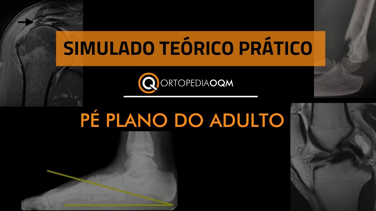 P&eacute; Plano do adulto! Simulado Te&oacute;rico-Pr&aacute;tico OQM #DeOlhoNOTEOT SBOT Ortopedia OQM