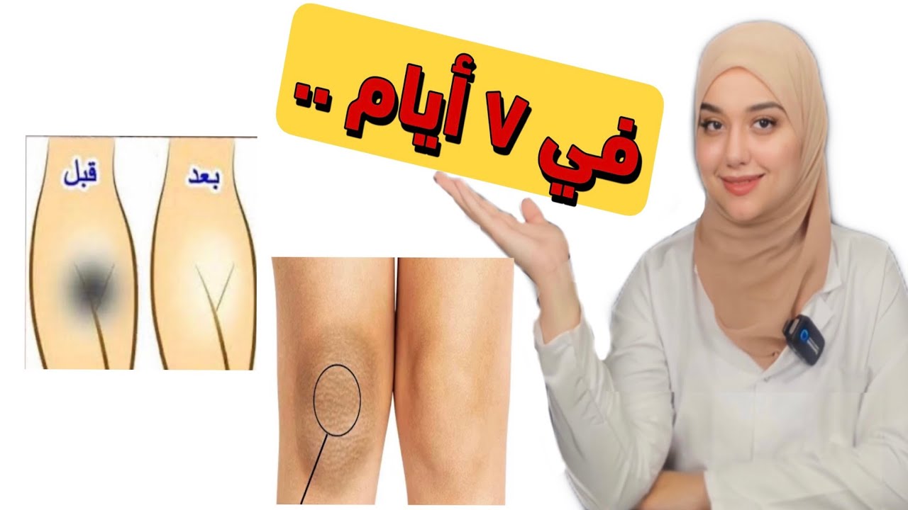 اسرع وصفة لتفتيح اسمرار الاماكن الاحساسه و الركب و الأكواع و اى مكان غامق في الجسم فى اسبوع بس