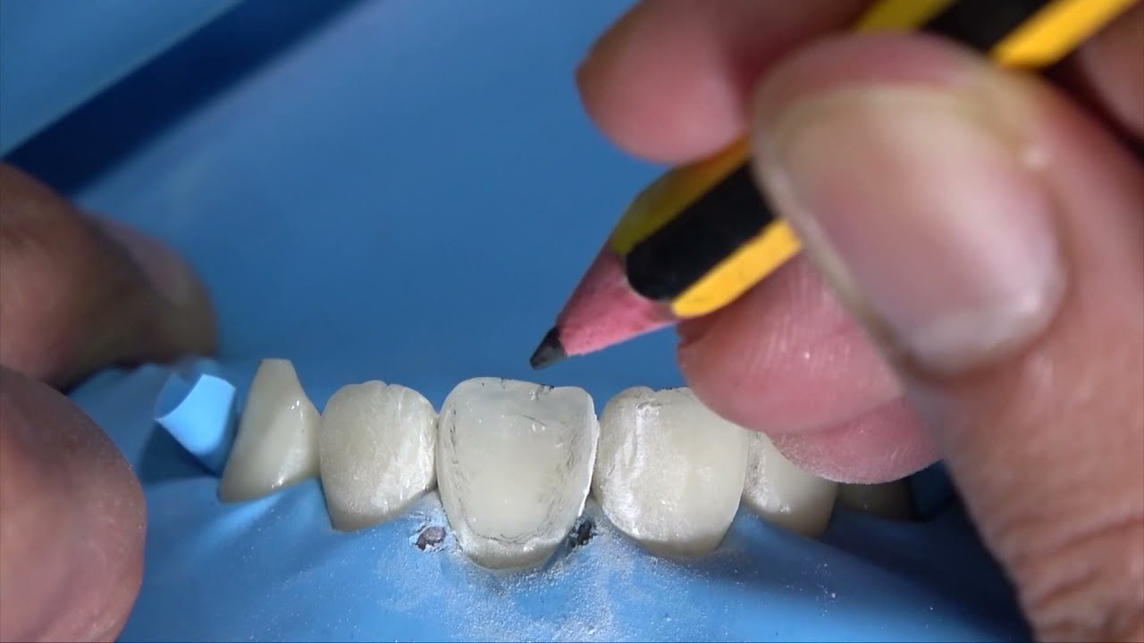 HOW TO MAKE GOOD LINE ANGLE ON ANTERIOR TOOTH