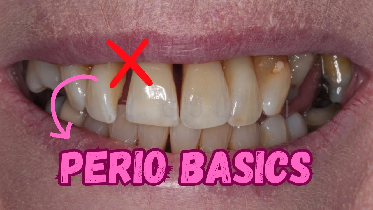 Periodontics for Beginners - PS008